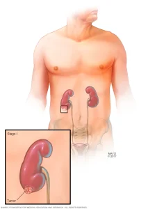 سرطان کلیه چیست؟ علائم، علل، تشخیص و درمان سرطان کلیه