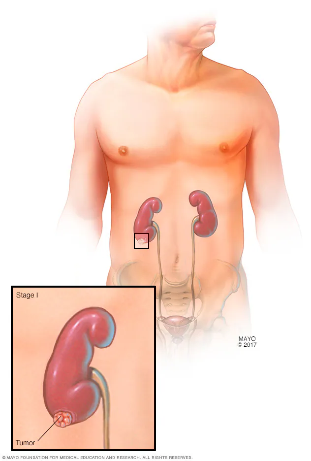 سرطان کلیه چیست؟ علائم، علل، تشخیص و درمان سرطان کلیه