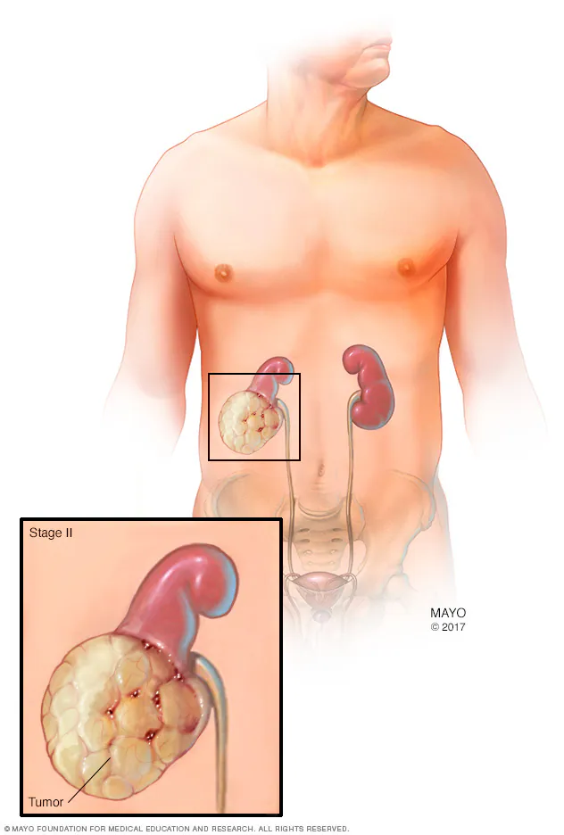 سرطان کلیه چیست؟ علائم، علل، تشخیص و درمان سرطان کلیه