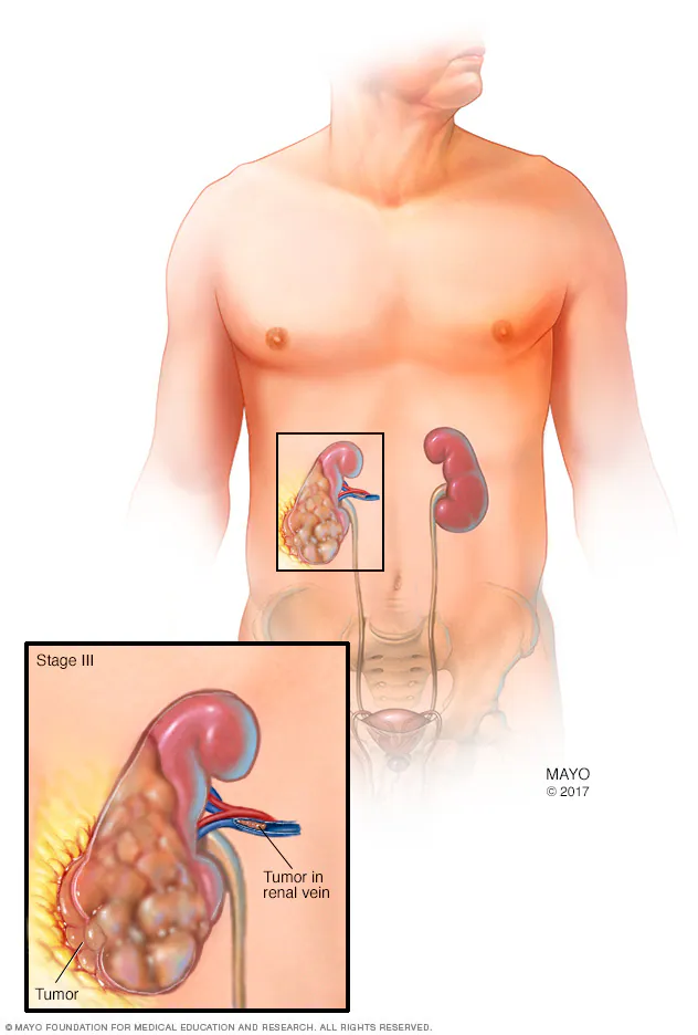 سرطان کلیه چیست؟ علائم، علل، تشخیص و درمان سرطان کلیه