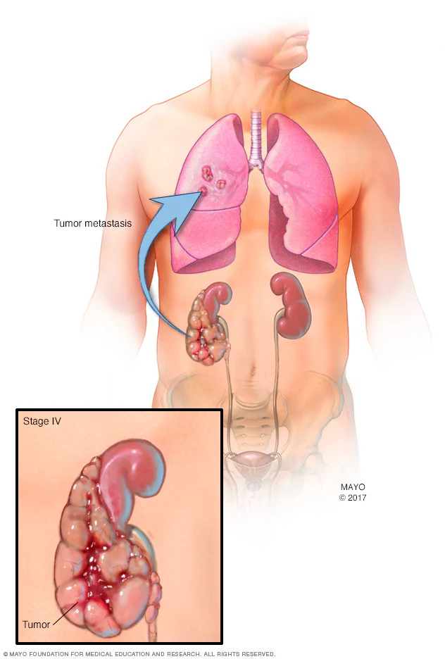 سرطان کلیه چیست؟ علائم، علل، تشخیص و درمان سرطان کلیه